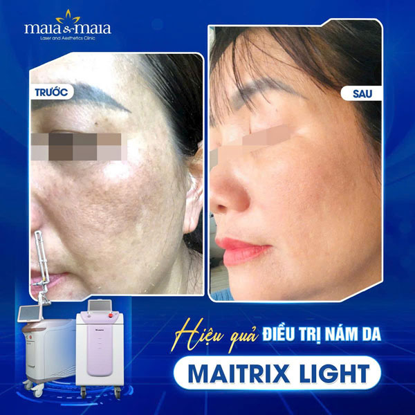 Cấu trúc da nám là gì? Giải mã chi tiết và cách điều trị  6 hiệu quả trị nám tại maia