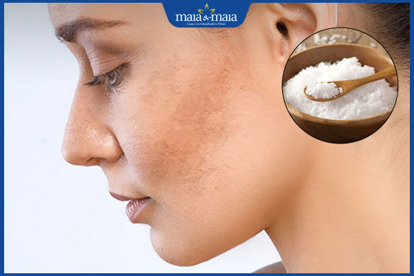 hiệu quả trị nám với muối