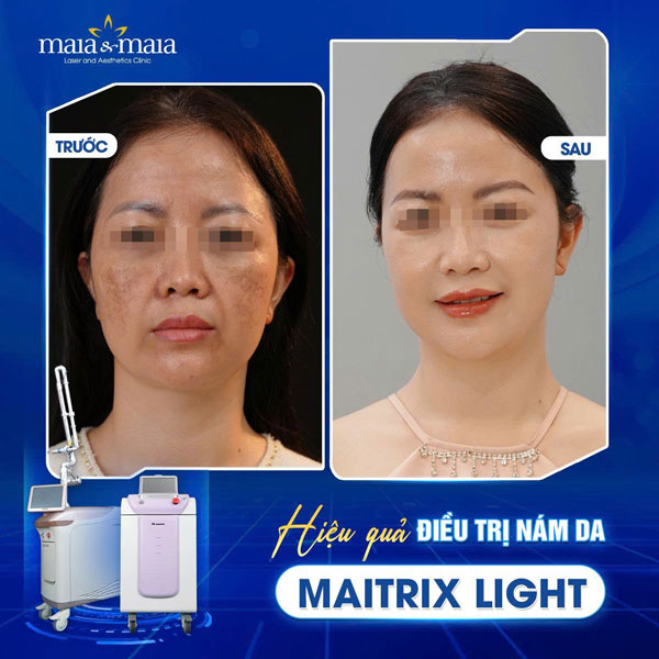 Cấu trúc da nám là gì? Giải mã chi tiết và cách điều trị  7 khách điều trị nám thành công