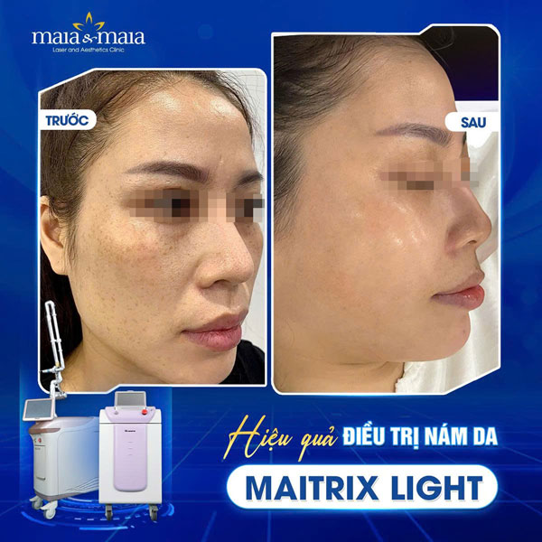 Cấu trúc da nám là gì? Giải mã chi tiết và cách điều trị  8 khách trị nám tại maia