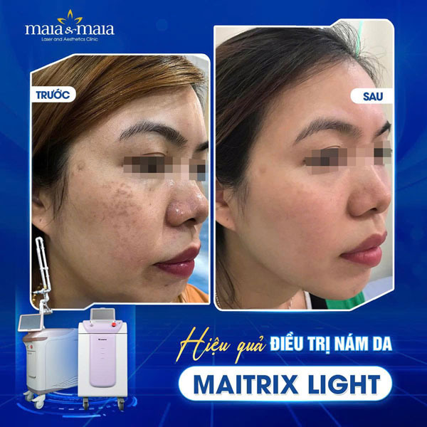 Cấu trúc da nám là gì? Giải mã chi tiết và cách điều trị  9 khách trị nám thành công tại maia