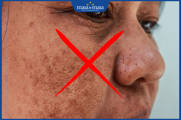 Top 7 công thức trị nám bằng lá mồng tơi an toàn tại nhà 6 không cải thiện với nám đậm màu