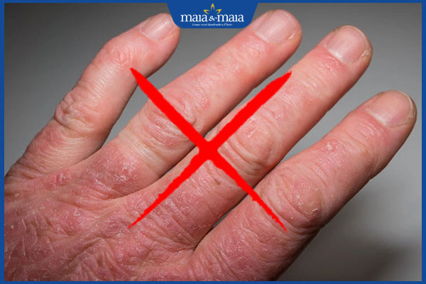 không triệt lông khi viêm da