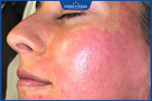 kich ung sau lan kim