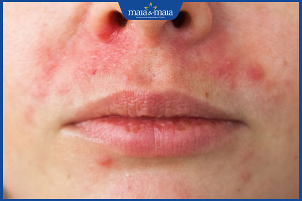 Triệt lông mép có ảnh hưởng gì không? Cần những lưu ý gì?  3 kích ứng vùng mép