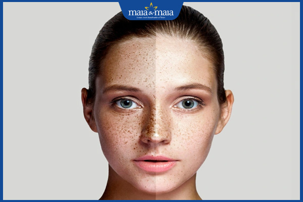 kiểm soát nám da