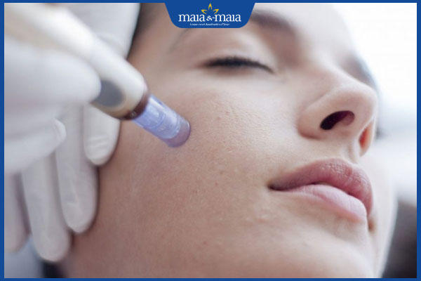 Phi kim trị nám có hiệu quả không? Bí kíp đạt hiệu quả cao 2 kỹ thuật phi kim