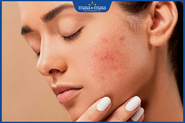 làn da nhạy cảm