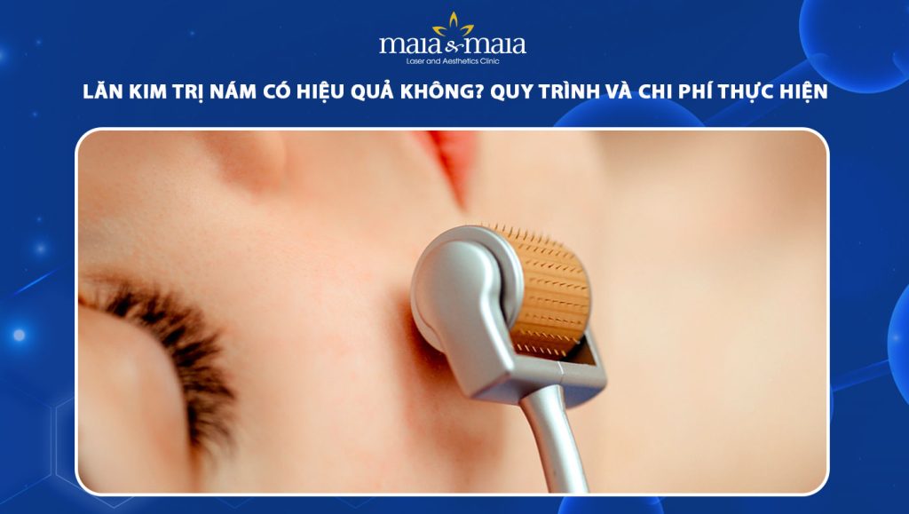 Lăn kim trị nám có hiệu quả không? Quy trình và chi phí thực hiện 1 lăn kim trị nám