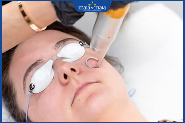 Trị nám bằng Laser Helios III: Quy trình và hiệu quả làm đẹp 2 laser helios iii