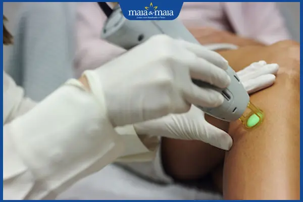 laser trị nám ở chân