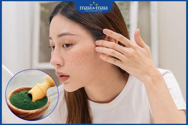 Gợi ý 6 cách trị nám bằng tảo xoắn, dưỡng da an toàn tại nhà 2 lợi ích của tảo xoắn