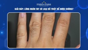 Giải đáp: Lông ngón tay có loại bỏ triệt để được không? 73 lông ngón tay