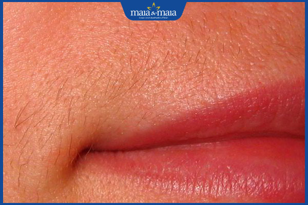 Triệt lông mép có ảnh hưởng gì không? Cần những lưu ý gì?  2 lông vùng mép