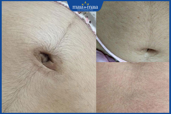 mẹ bầu mọc nhiều lông