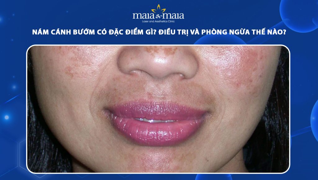 nám cánh bướm