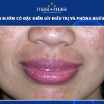 nám cánh bướm