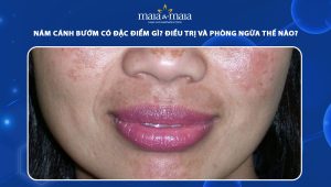 Nám cánh bướm có đặc điểm gì? Điều trị và phòng ngừa thế nào? 68 nám cánh bướm