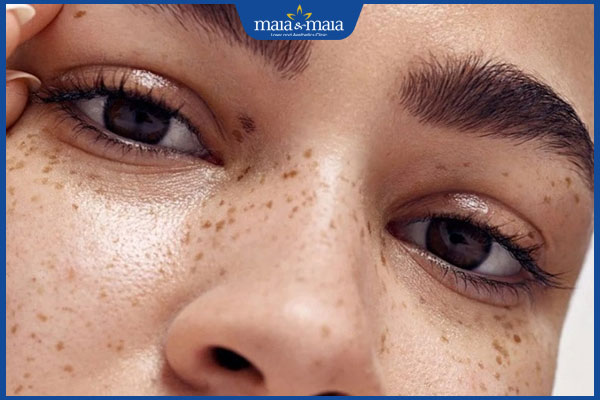 Nám chân đinh là gì? Bí quyết xóa nám tận gốc nhanh chóng 2 nám chân đinh