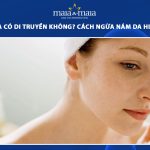 nám da có di truyền không