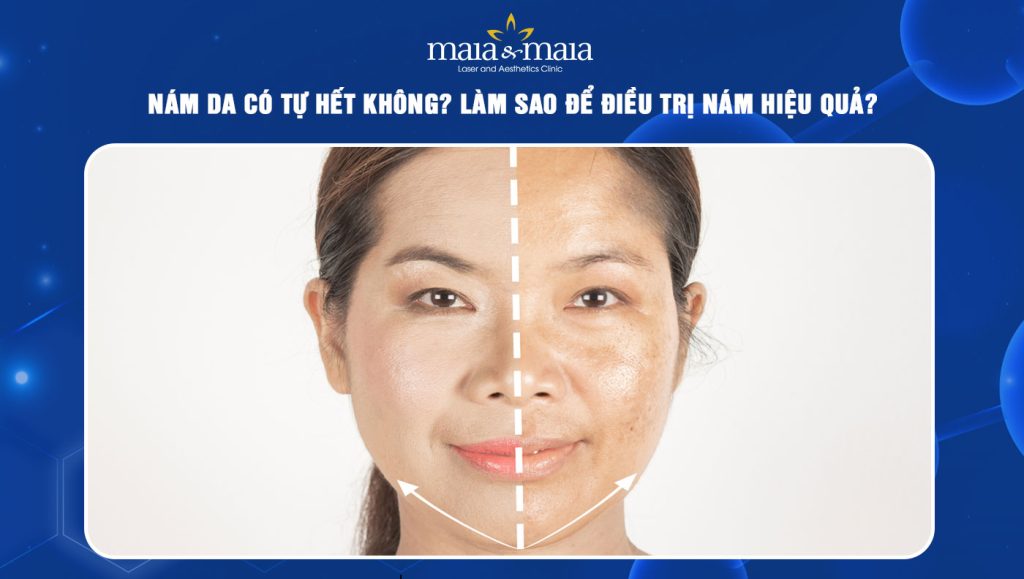 Nám da có tự hết không? Làm sao để điều trị nám hiệu quả? 1 nám da có tự hết không