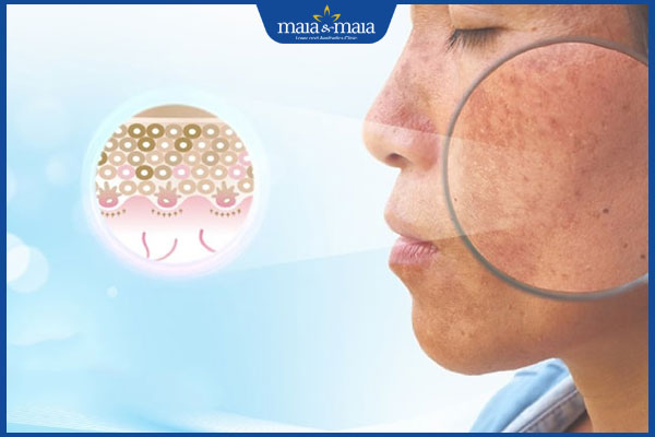 Nám da có di truyền không? Cách ngừa nám da hiệu quả 2 nám da do gen