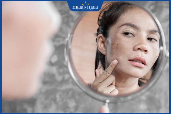 Thức khuya có bị nám da không? Cách cải thiện nám hiệu quả  2 nám da do thức khuya