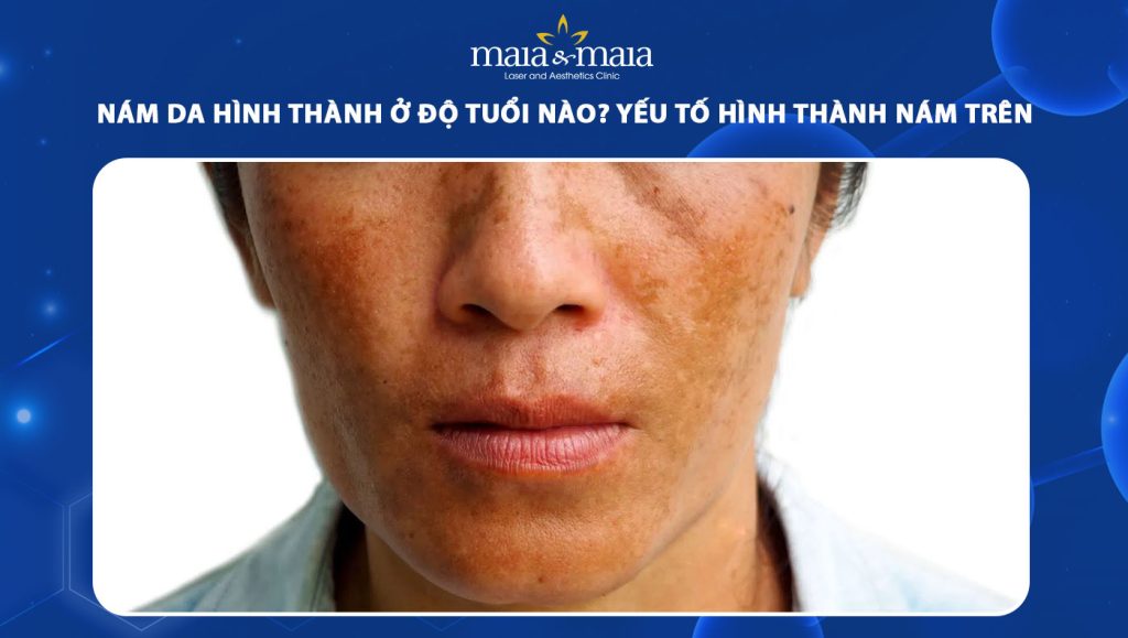 nám da hình thành ở độ tuổi nào
