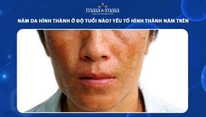 Nám da hình thành ở độ tuổi nào? Yếu tố hình thành nám trên da 41 nám da hình thành ở độ tuổi nào