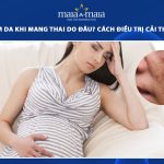 nám da khi mang thai