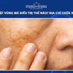 nám da mặt vùng má