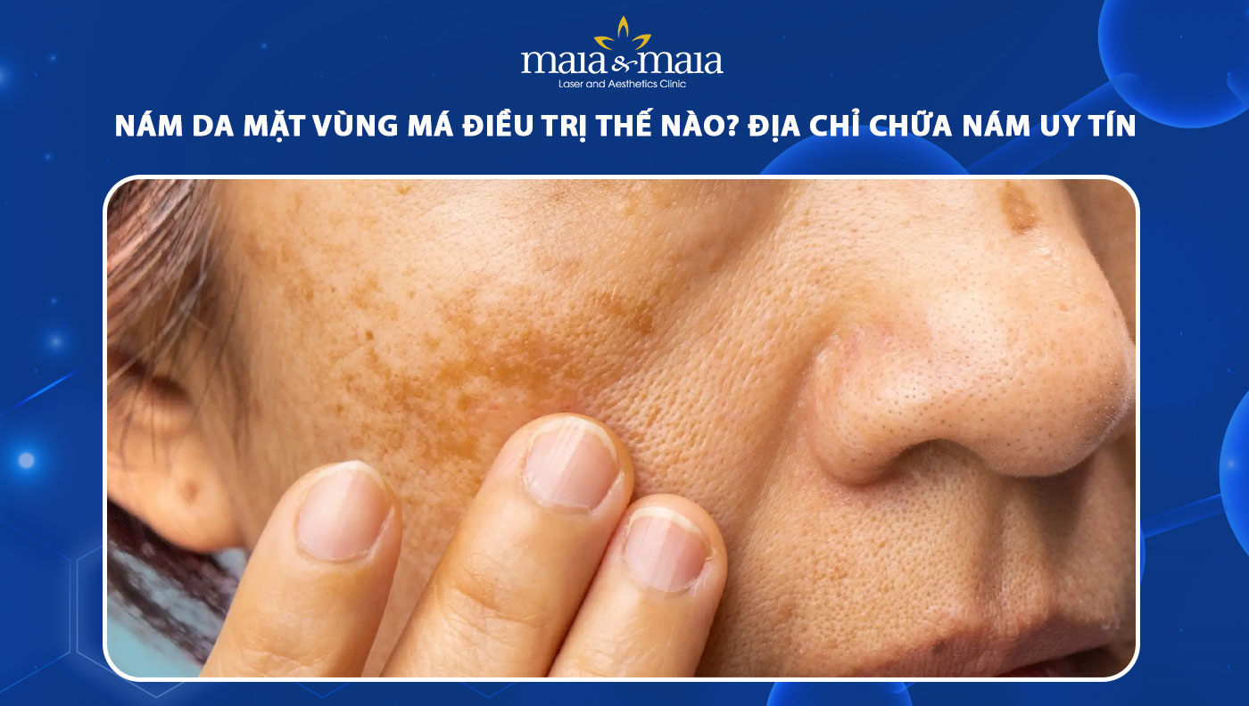 nám da mặt vùng má
