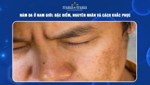 Nám da ở nam giới: Đặc điểm, nguyên nhân và cách khắc phục 70 nám da ở nam giới