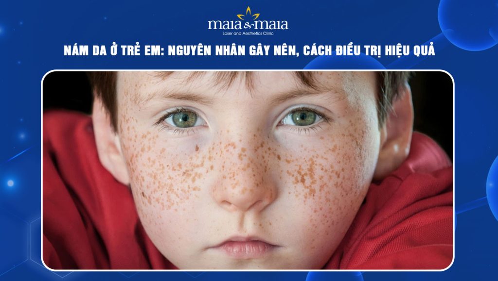 nám da ở trẻ em
