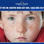 nám da ở trẻ em
