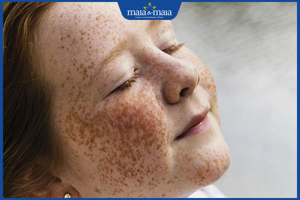nám da ở trẻ lan nhanh