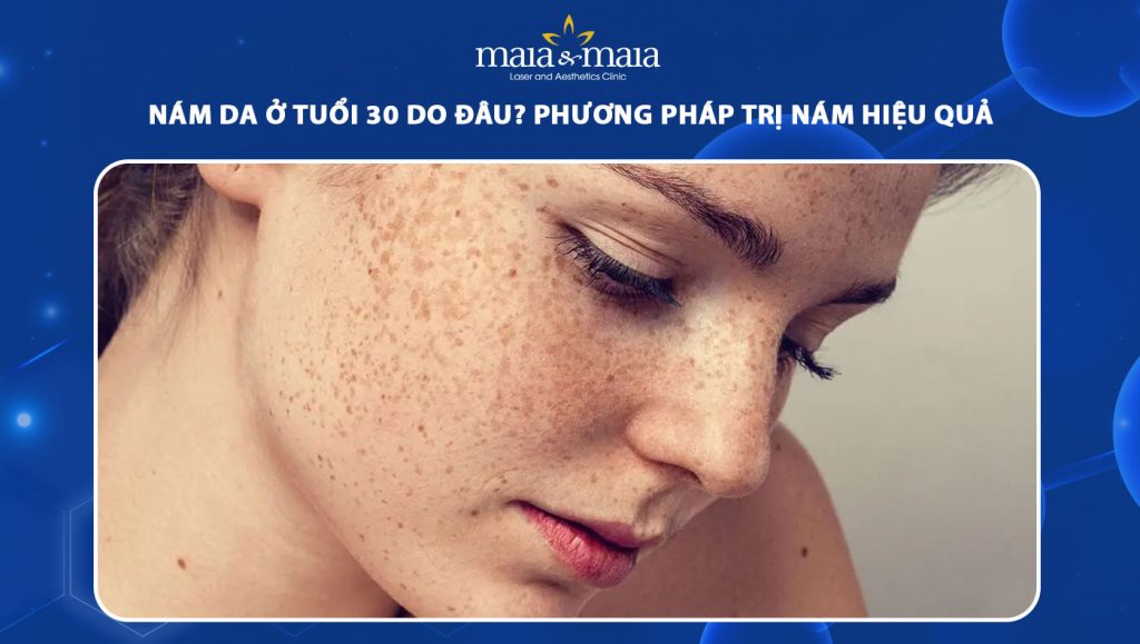 nám da ở tuổi 30 phổ biến
