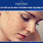 nám da ở tuổi 30 phổ biến