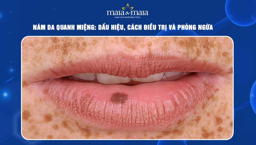 nám da quanh miệng