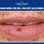 nám da quanh miệng