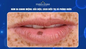 Nám da quanh miệng: Dấu hiệu, cách điều trị và phòng ngừa 45 nám da quanh miệng
