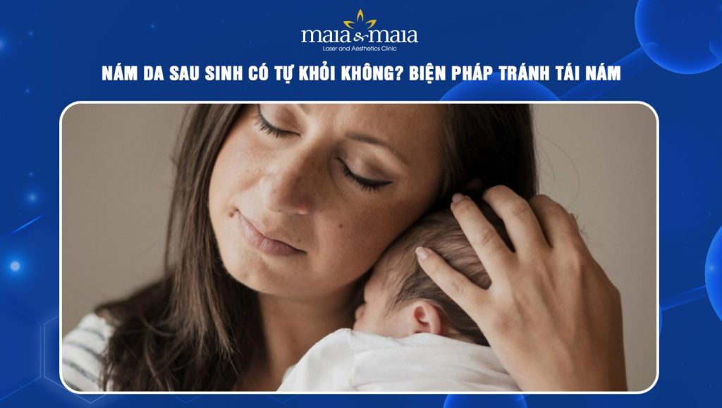 nám da sau sinh