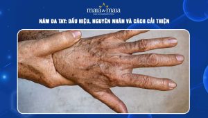 Nám da tay: Dấu hiệu, nguyên nhân và cách cải thiện 79 nám da tay