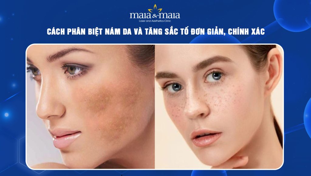 nám da và tăng sắc tố