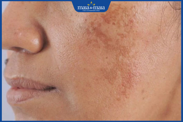 Nám da ở nam giới: Đặc điểm, nguyên nhân và cách khắc phục 2 nám hỗn hợp ở nam giới