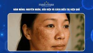 Nám mảng: Nguyên nhân, dấu hiệu và cách điều trị hiệu quả 98 nam mảng