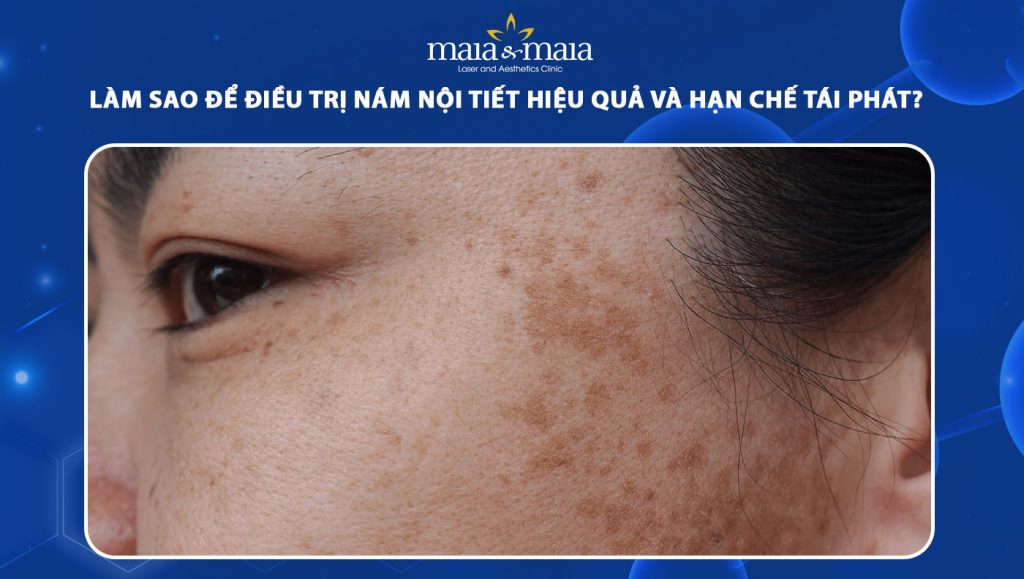 Làm sao để điều trị nám nội tiết hiệu quả và hạn chế tái phát? 1 nám nội tiết