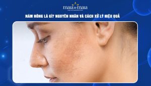 Nám nông là gì? Nguyên nhân và cách xử lý hiệu quả 101 nám nông