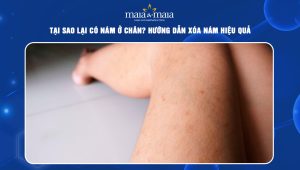 Tại sao lại có nám ở chân? Hướng dẫn xóa nám hiệu quả 102 nám ở chân