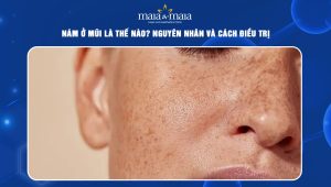 Nám ở mũi là thế nào? Nguyên nhân và cách điều trị 46 nám ở mũi